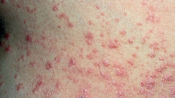 Guttate Psoriasis: Causes, Symptoms, Treatments, and Complications | Guttate Psoriasis