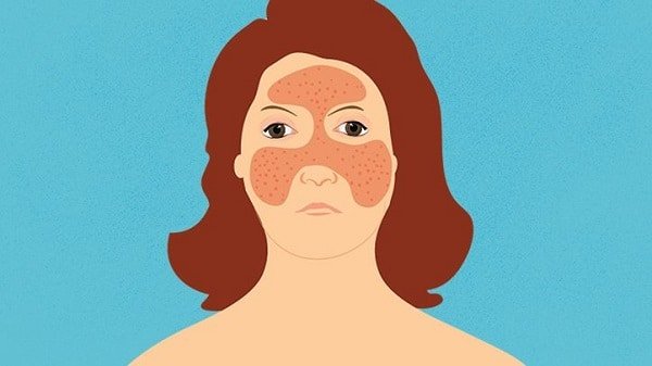 How to Identify Lupus Rash and Other Skin Symptoms of the Condition | Lupus Rash