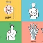 What Is Rheumatoid Arthritis? Symptoms, Causes, Diagnosis, Treatment, and Prevention