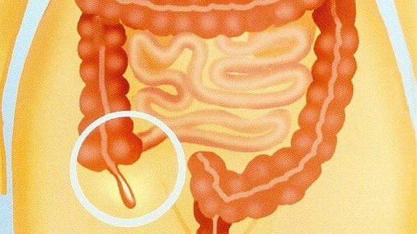 What Is the Appendix? A Vestigial Organ, or One With a Purpose? | What Does the Appendix Do