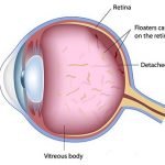 Q: What are eye floaters, and are they dangerous?