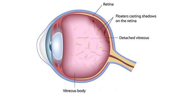 Q: What are eye floaters, and are they dangerous?