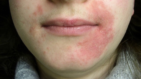 What Is Perioral Dermatitis? Symptoms, Causes, Diagnosis, Treatment, and Prevention