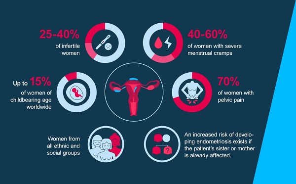 Endometriosis : Symptoms, Causes, Risk factors, Complications & More !