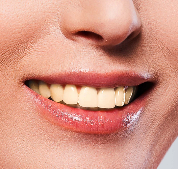 Dental Retainers: Everything You Need to Know!