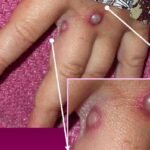 Monkeypox Virus Infection | How Many Cases In India ?